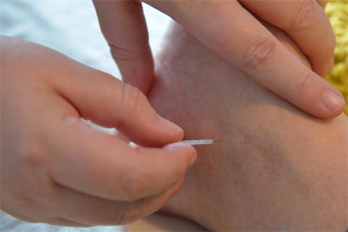 Akupunktur mod myggestik, 30 minutter